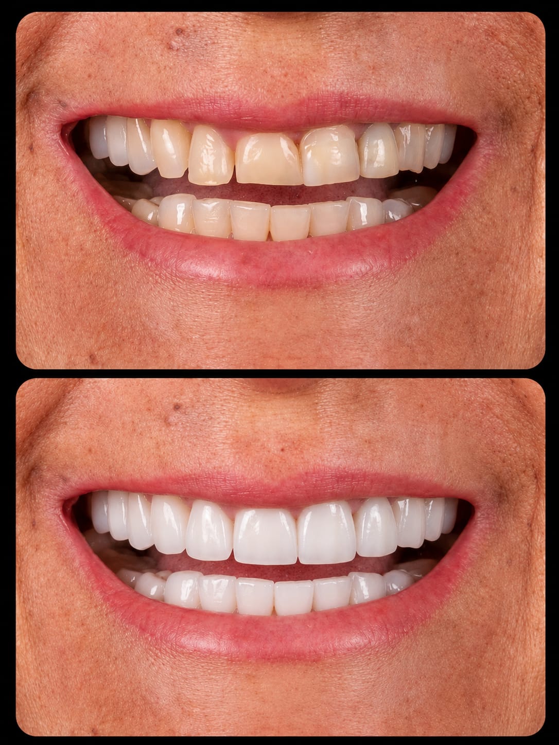 Prótese dentária de alto padrão